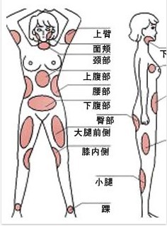 抽脂减肥治不了肥胖